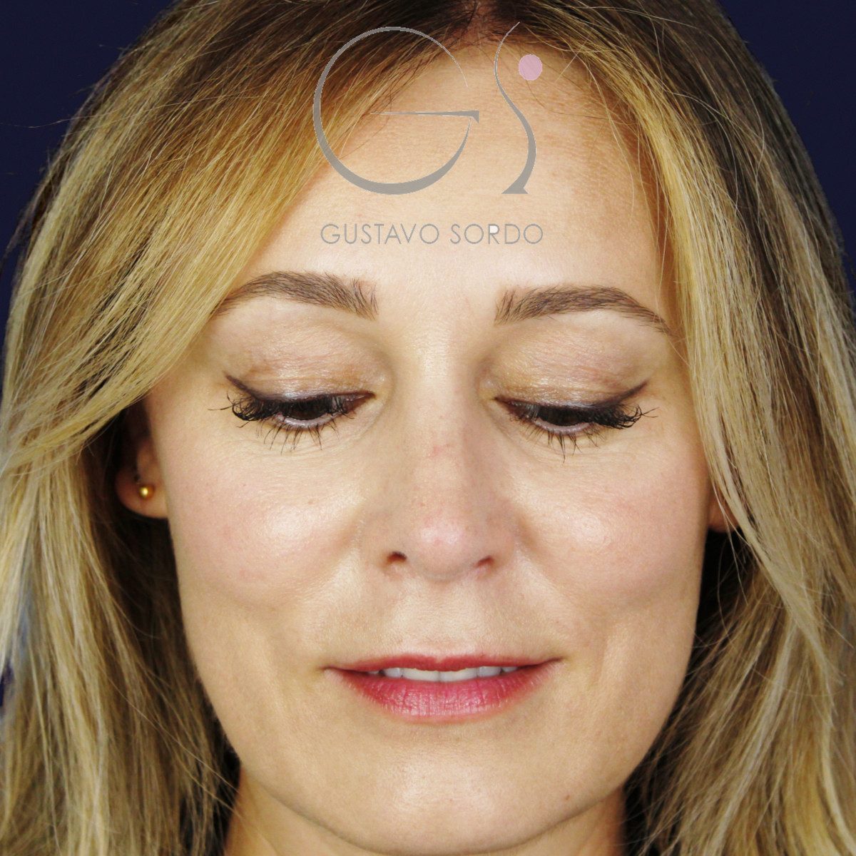Después de rinoplastia ultrasónica con columela colgante y ala retraída, a los dos meses, vista frontal con el mentón abajo