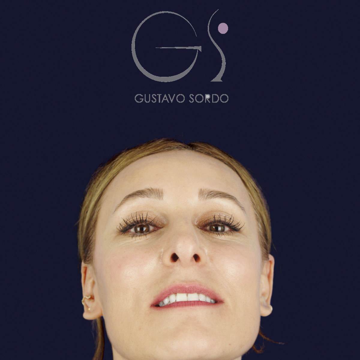 Antes de rinoplastia ultrasónica con columela colgante y ala retraída, vista frontal con el mentón arriba