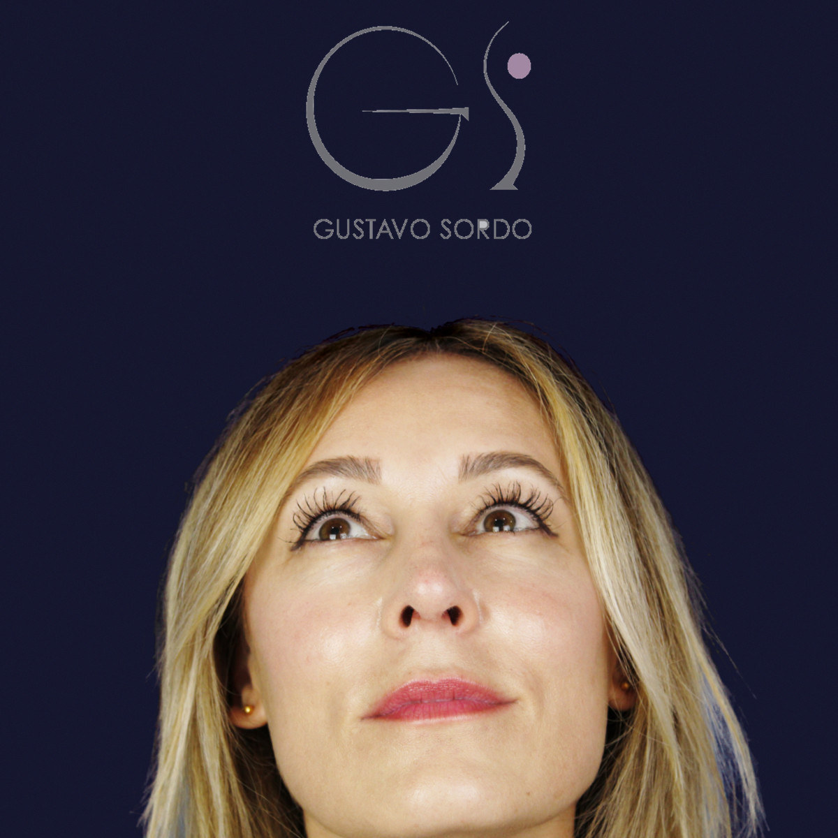 Después de rinoplastia ultrasónica con columela colgante y ala retraída, a los dos meses, vista frontal con el mentón arriba
