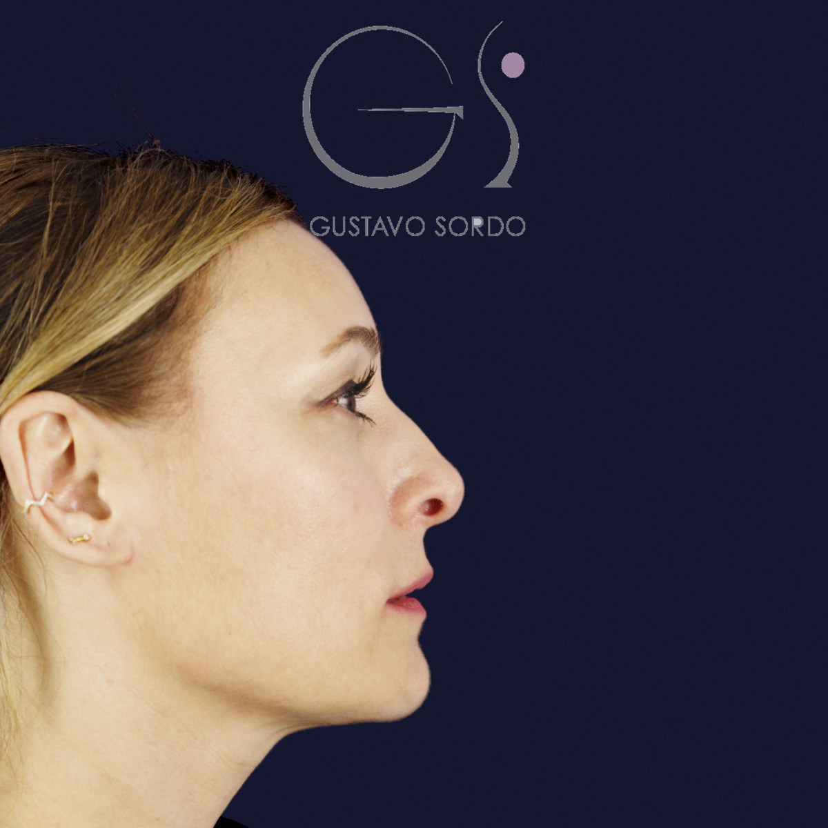 Antes de rinoplastia ultrasónica con columela colgante y ala retraída, vista de perfil derecho