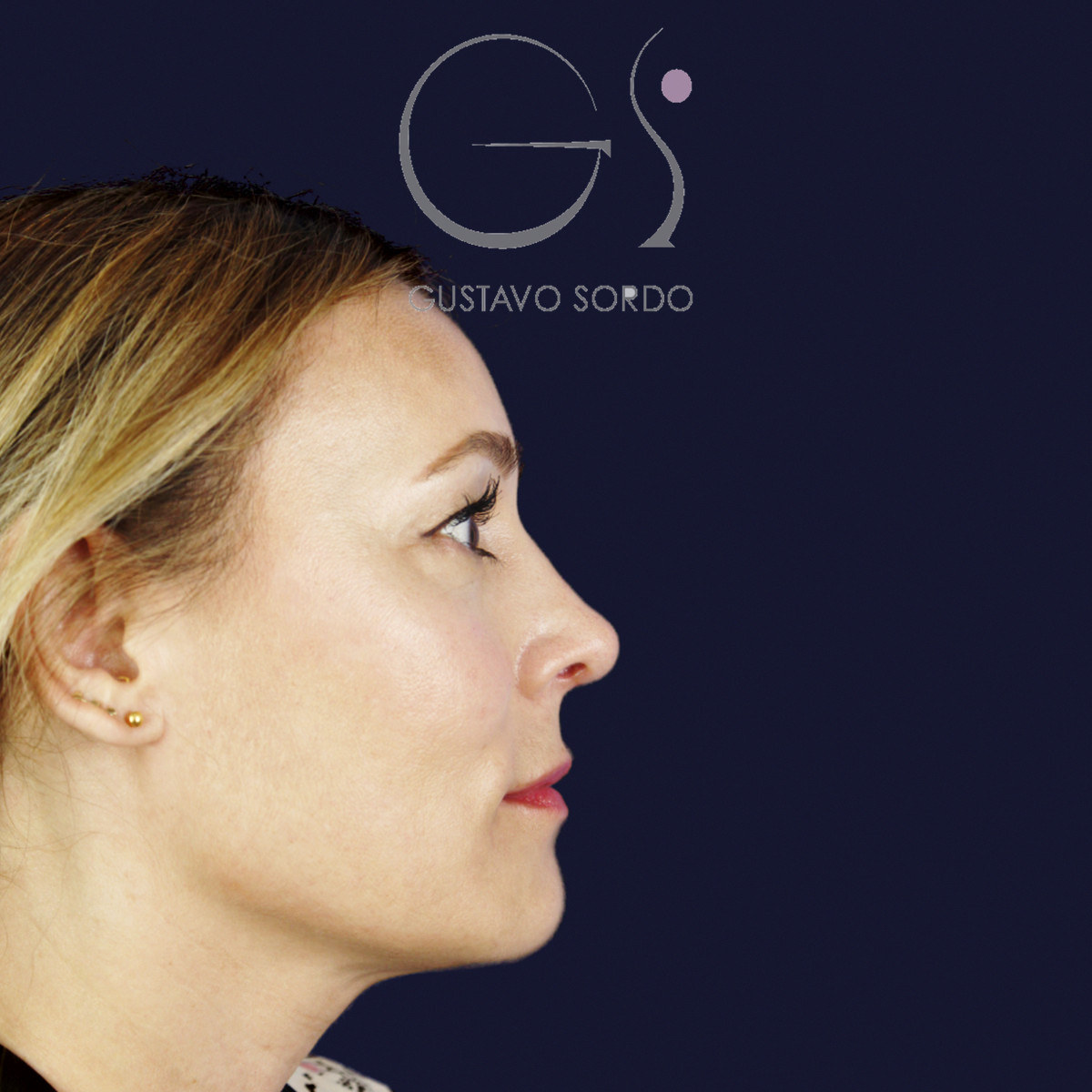 Después de rinoplastia ultrasónica con columela colgante y ala retraída, a los dos meses, vista de perfil derecho