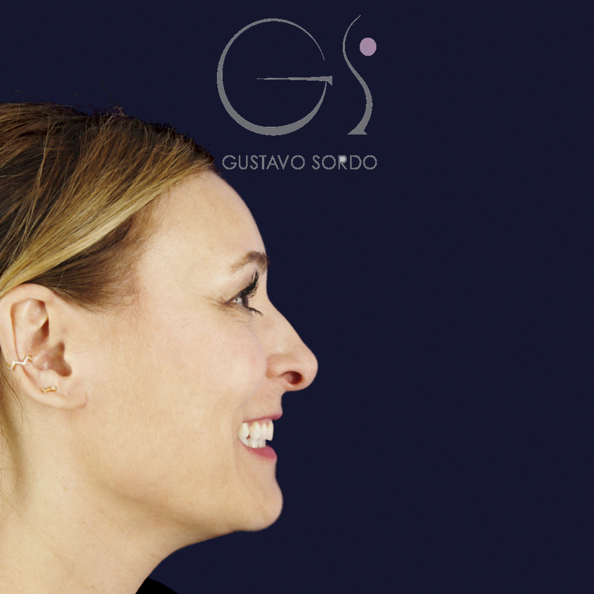 Antes de rinoplastia ultrasónica con columela colgante y ala retraída, vista de perfil derecho sonriendo