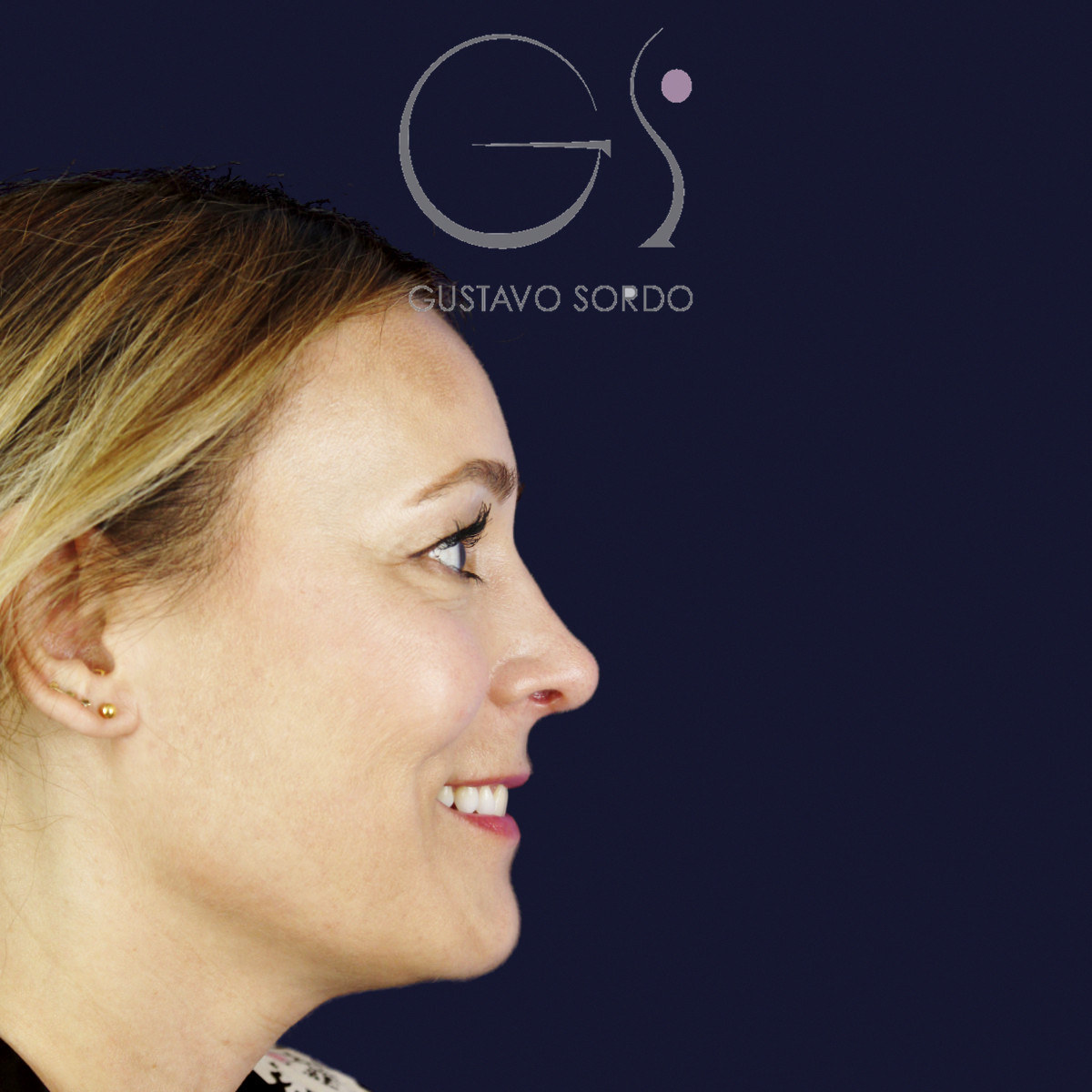 Después de rinoplastia ultrasónica con columela colgante y ala retraída, a los dos meses, vista de perfil derecho sonriendo