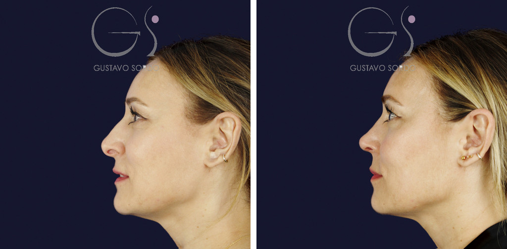 Rinoplastia ultrasónica con columela colgante y ala retraída: antes y a los dos meses, vista de perfil izquierdo