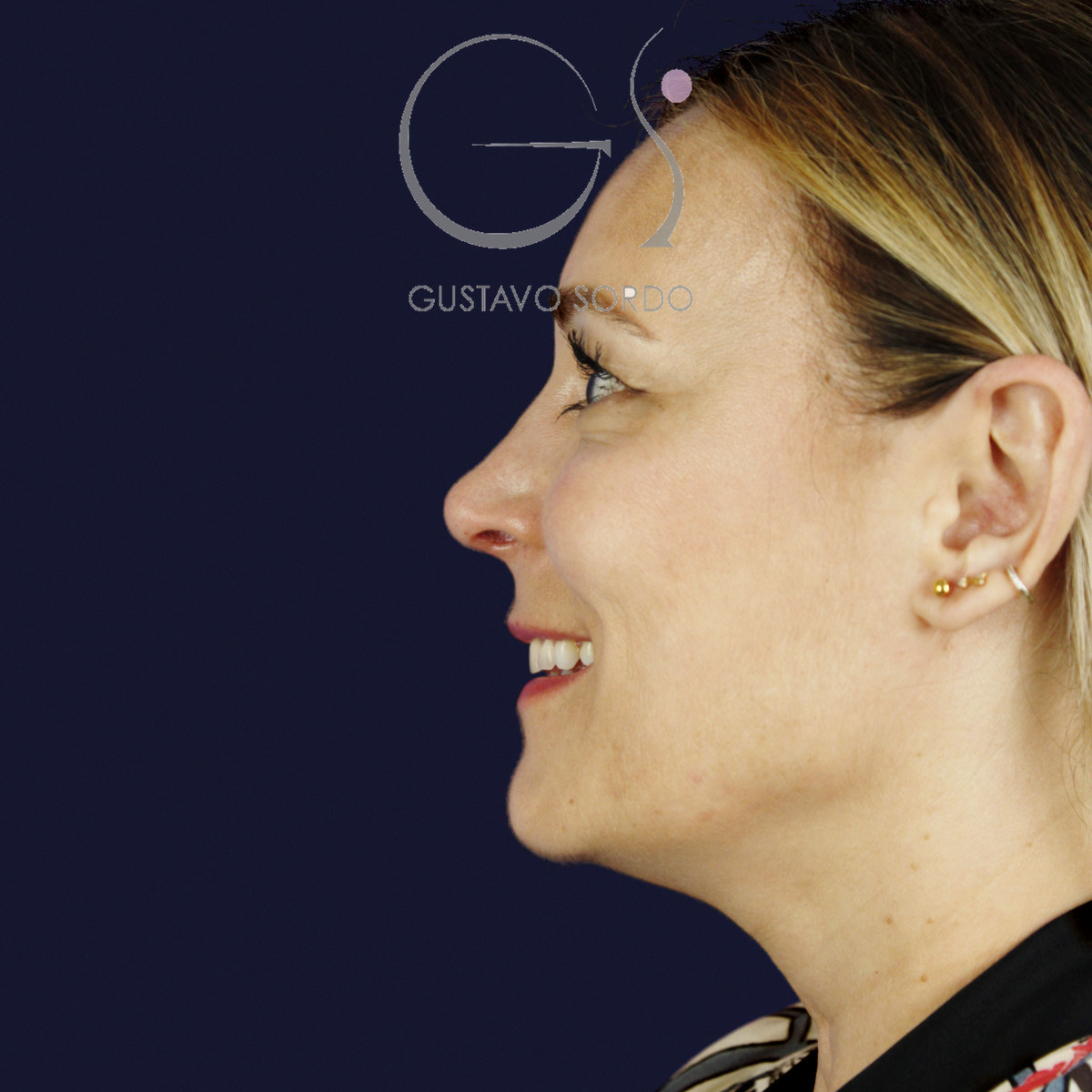 Después de rinoplastia ultrasónica con columela colgante y ala retraída, a los dos meses, vista de perfil izquierdo sonriendo