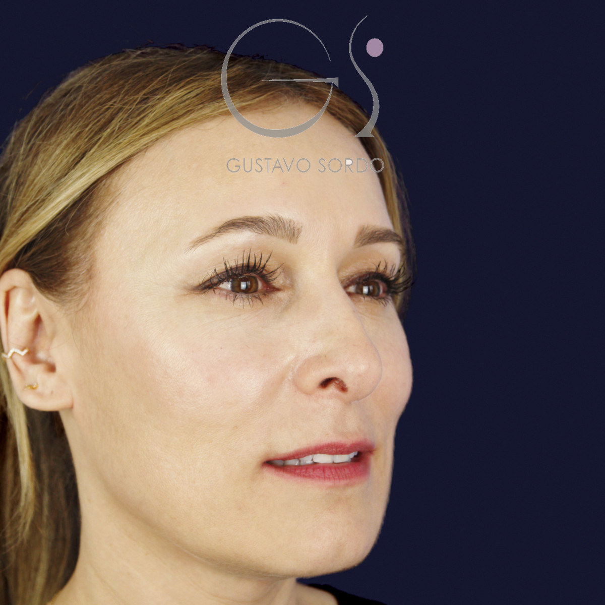 Antes de rinoplastia ultrasónica con columela colgante y ala retraída, vista de semiperfil derecho