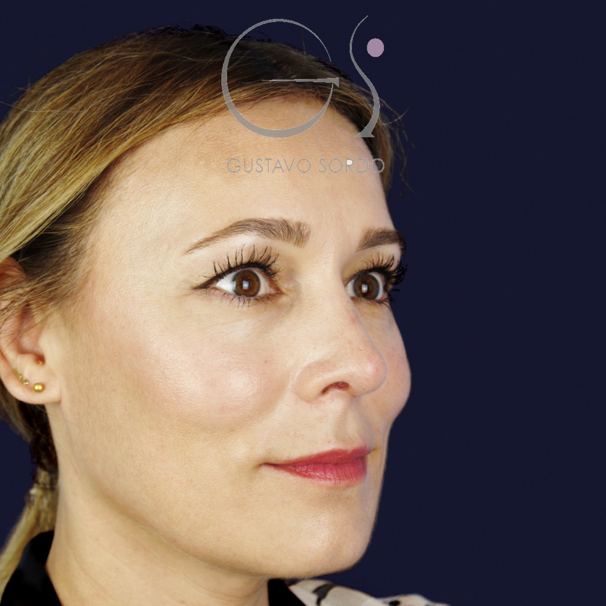 Después de rinoplastia ultrasónica con columela colgante y ala retraída, a los dos meses, vista de semiperfil derecho