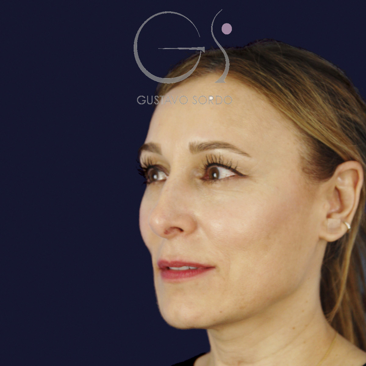 Antes de rinoplastia ultrasónica con columela colgante y ala retraída, vista de semiperfil izquierdo