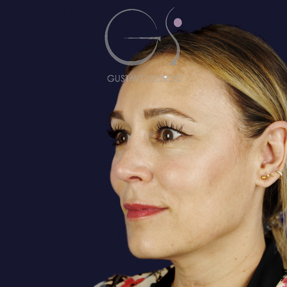 Después de rinoplastia ultrasónica con columela colgante y ala retraída, a los dos meses, vista de semiperfil izquierdo