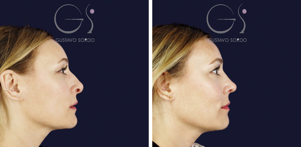 Rinoplastia ultrasónica con columela colgante y ala retraída: antes y a los dos meses, perfil derecho