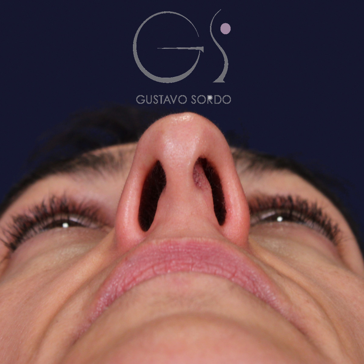 Rinoplastia de preservación con dorsal split y punta en armadillo, vista basal: antes de la operación