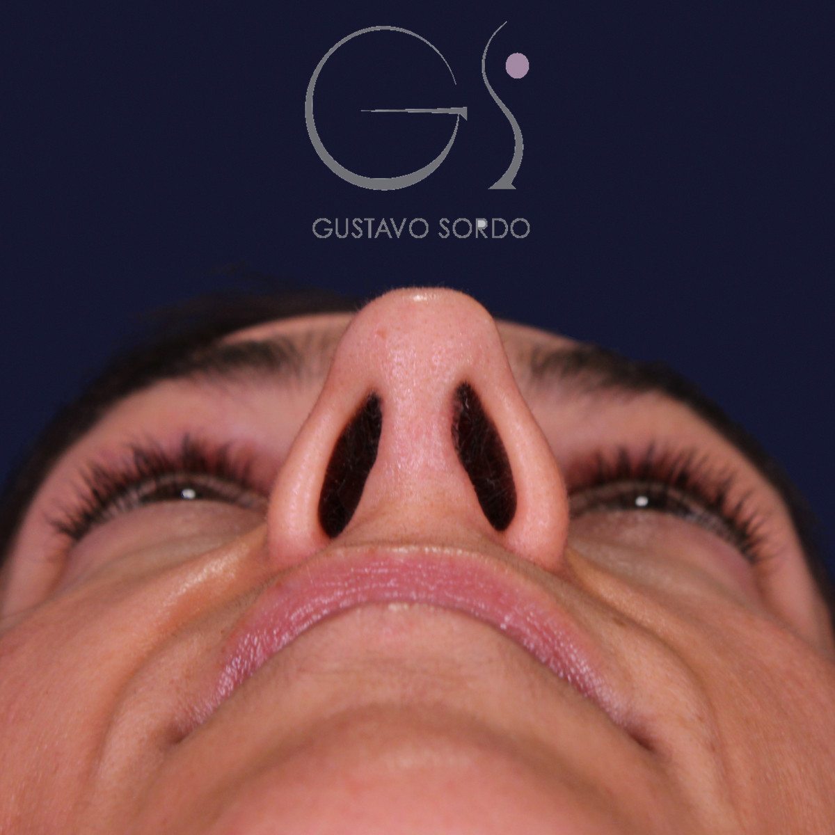 Rinoplastia de preservación con dorsal split y punta en armadillo, vista basal: resultado a los 6 meses