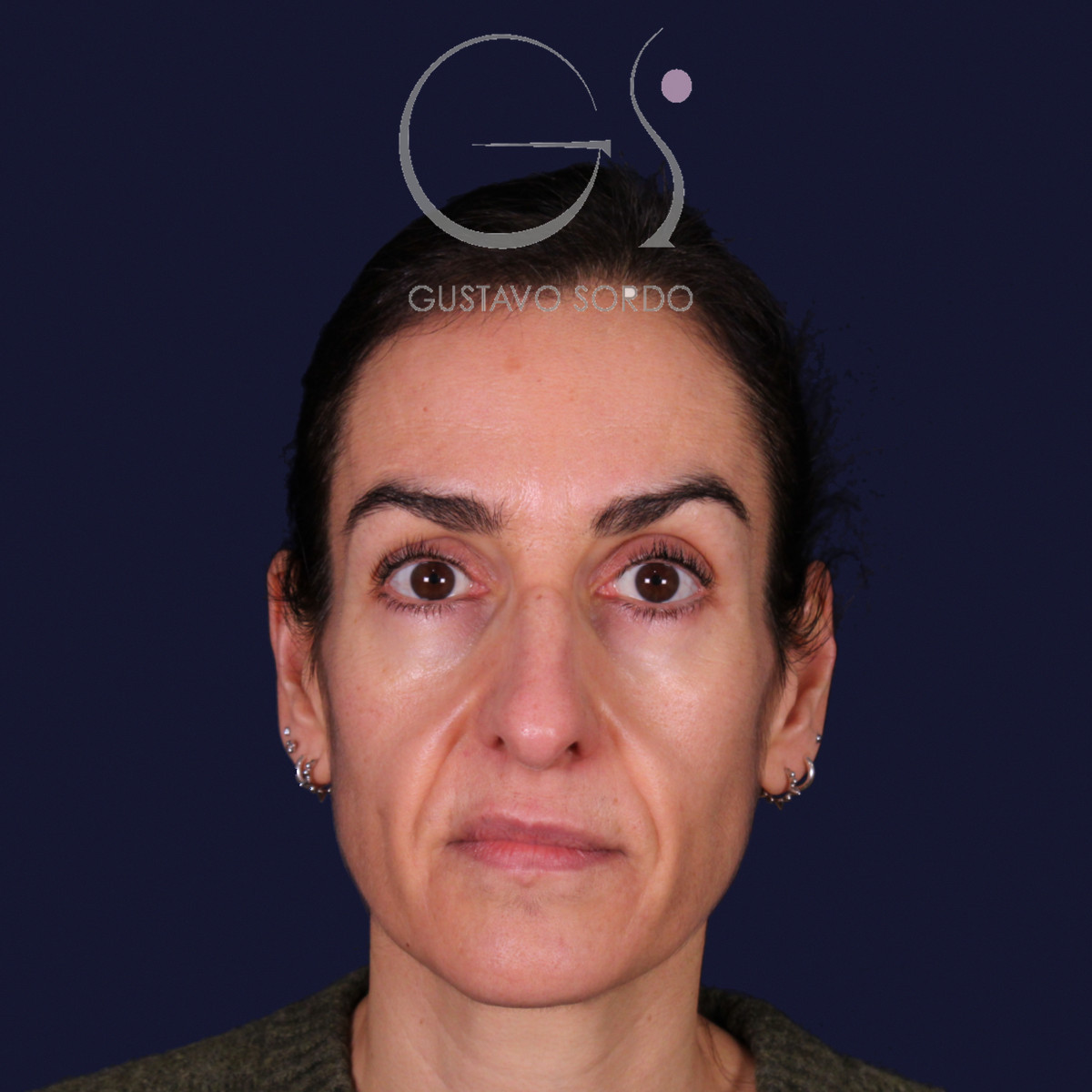 Rinoplastia de preservación con dorsal split y punta en armadillo, vista frontal: antes de la operación