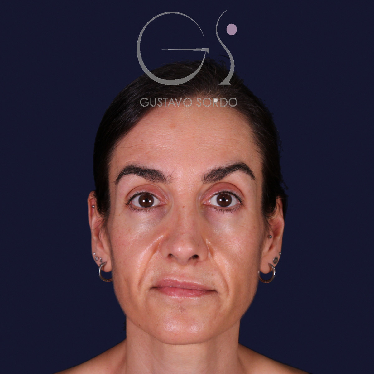 Rinoplastia de preservación con dorsal split y punta en armadillo, vista frontal: resultado a los 6 meses