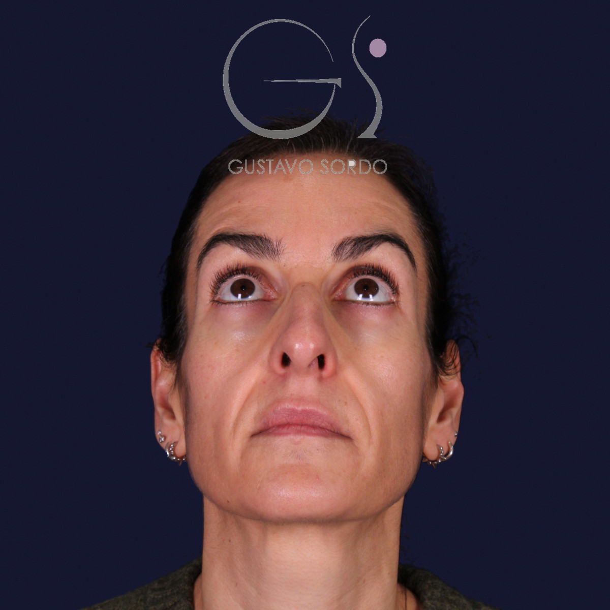 Rinoplastia de preservación con dorsal split y punta en armadillo, vista con el mentón arriba: antes de la operación