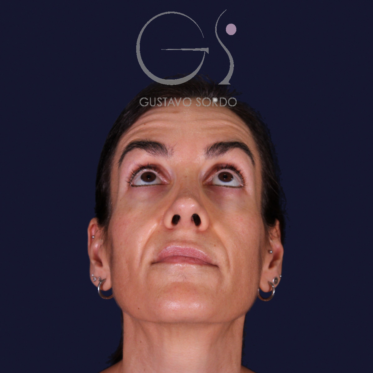 Rinoplastia de preservación con dorsal split y punta en armadillo, vista con el mentón arriba: resultado a los 6 meses