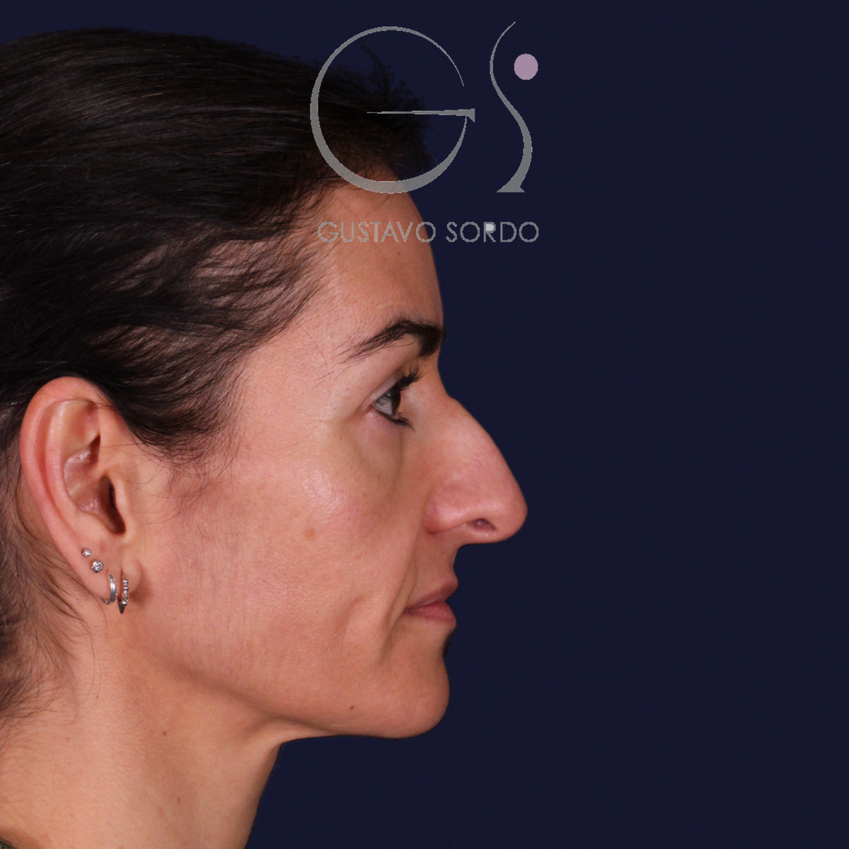 Rinoplastia de preservación con dorsal split y punta en armadillo, perfil derecho: antes de la operación