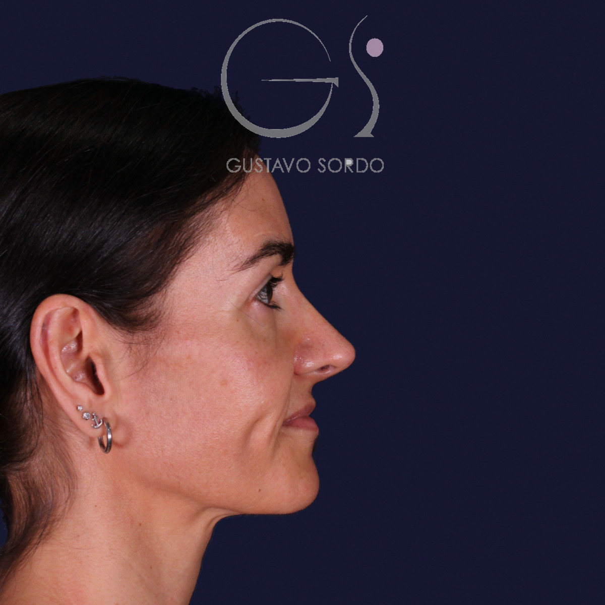 Rinoplastia de preservación con dorsal split y punta en armadillo, perfil derecho: resultado a los 6 meses