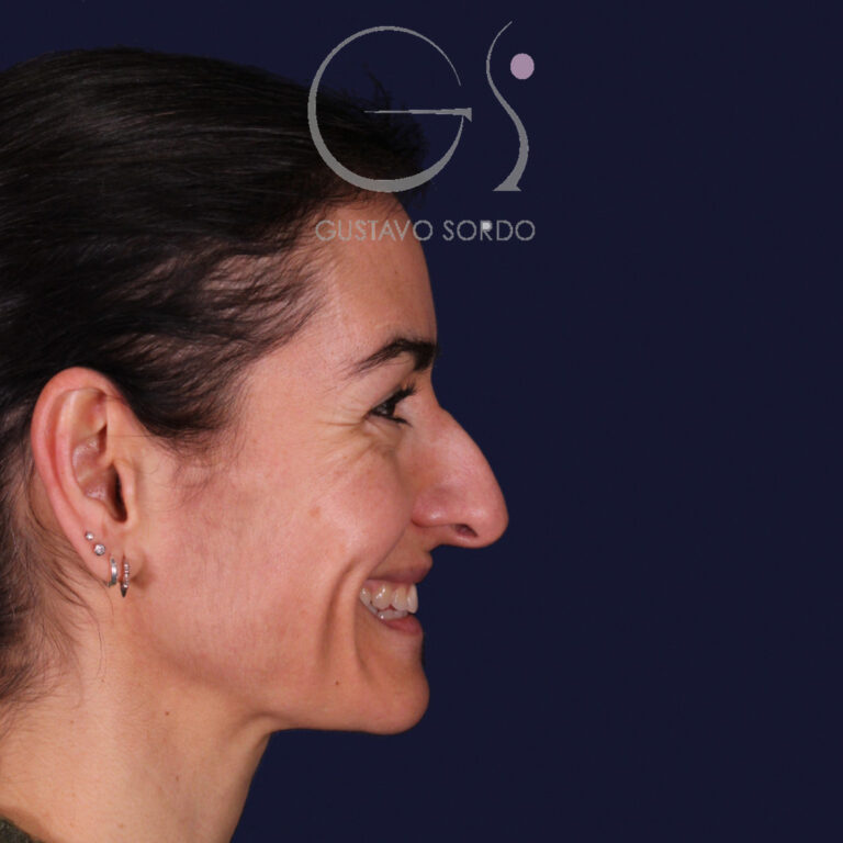 Rinoplastia ultrasónica en Madrid: perfil derecho antes y después (antes)