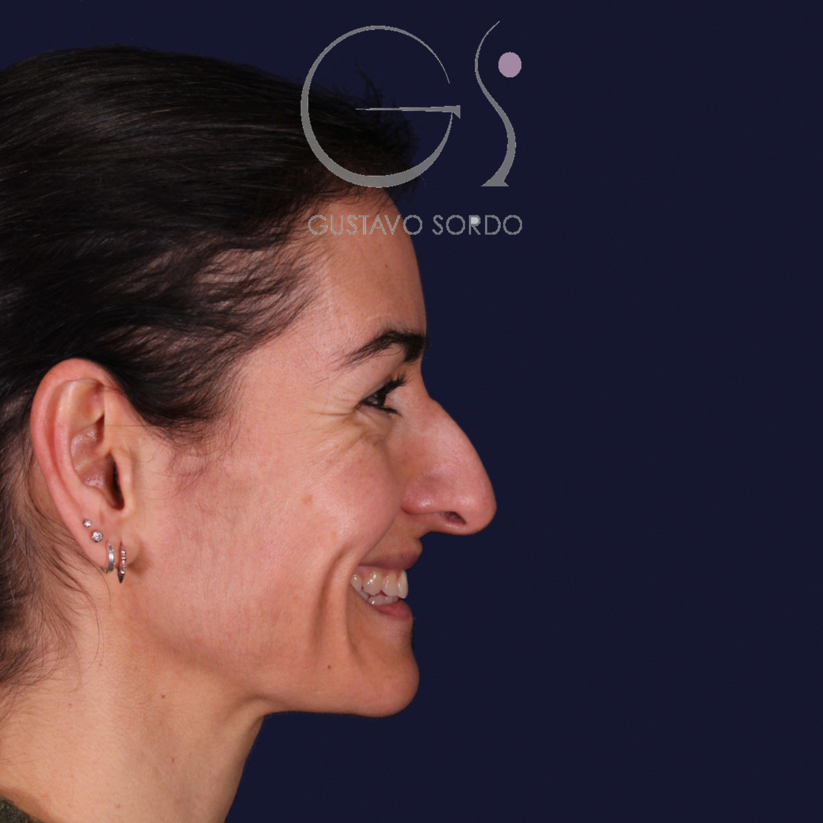 Rinoplastia de preservación con dorsal split y punta en armadillo, perfil derecho sonriendo: antes de la operación