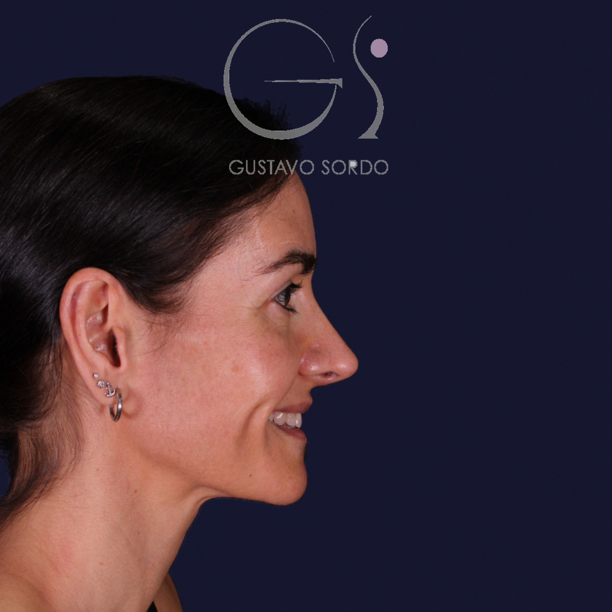 Rinoplastia de preservación con dorsal split y punta en armadillo, perfil derecho sonriendo: resultado a los 6 meses