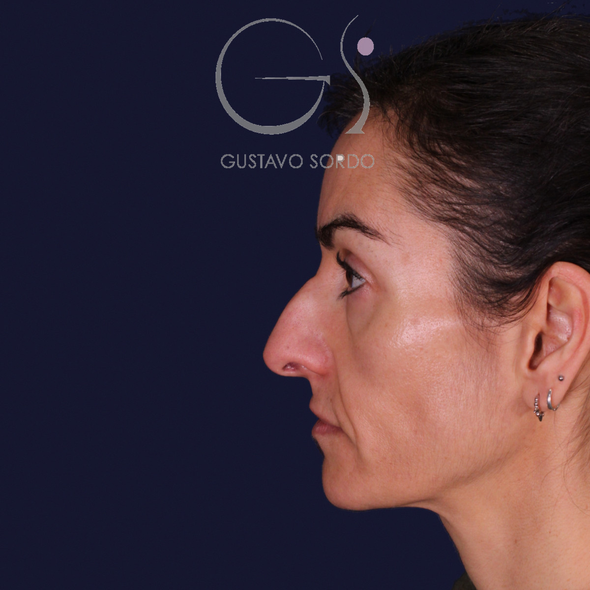 Rinoplastia de preservación con dorsal split y punta en armadillo, perfil izquierdo: antes de la operación
