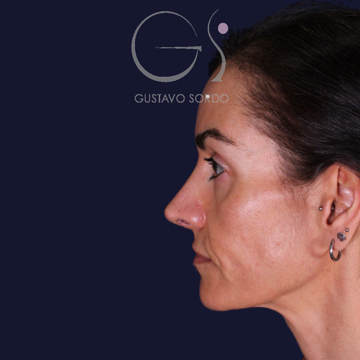 Rinoplastia de preservación con dorsal split y punta en armadillo, perfil izquierdo: resultado a los 6 meses