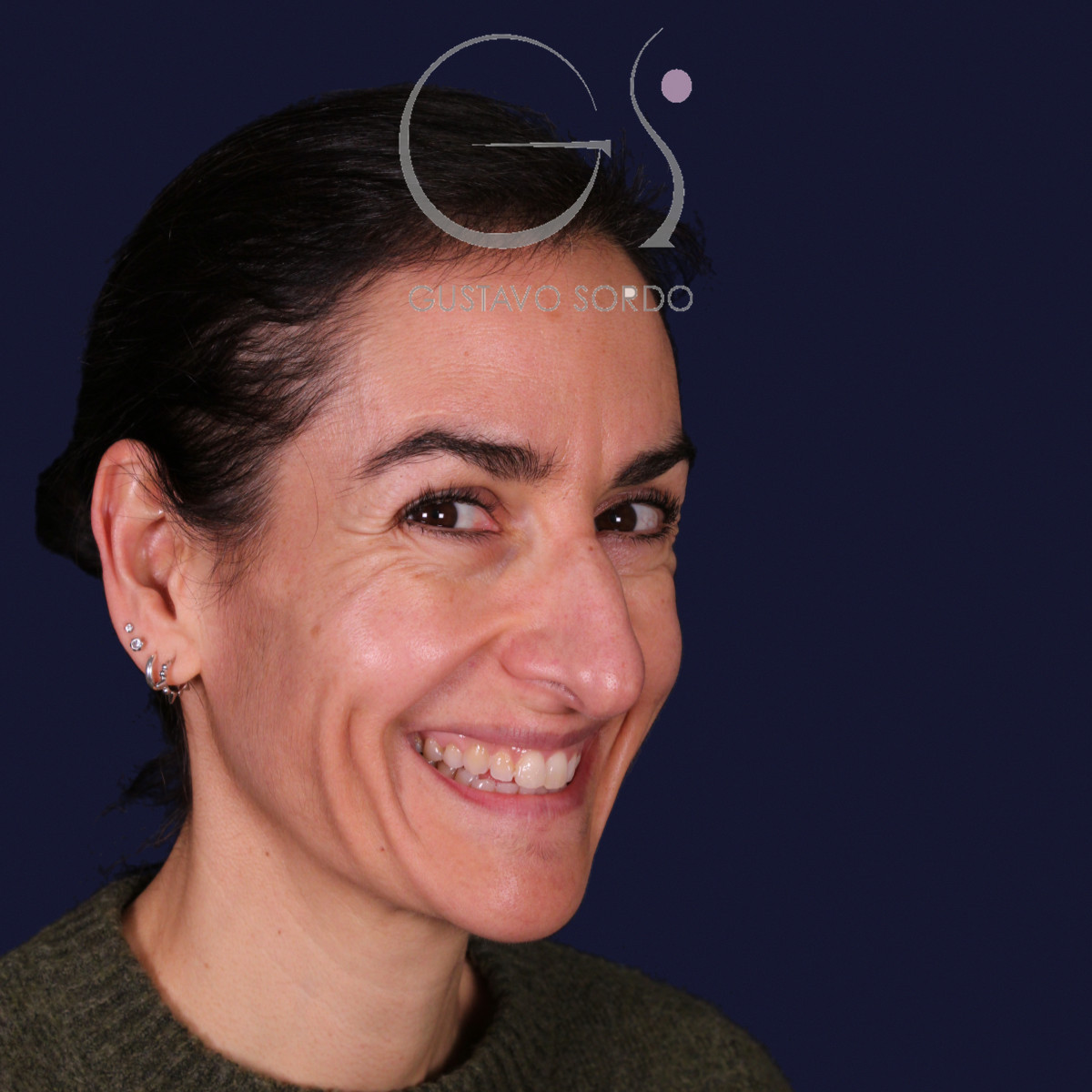 Rinoplastia de preservación con dorsal split y punta en armadillo, semiperfil derecho sonriendo: antes de la operación