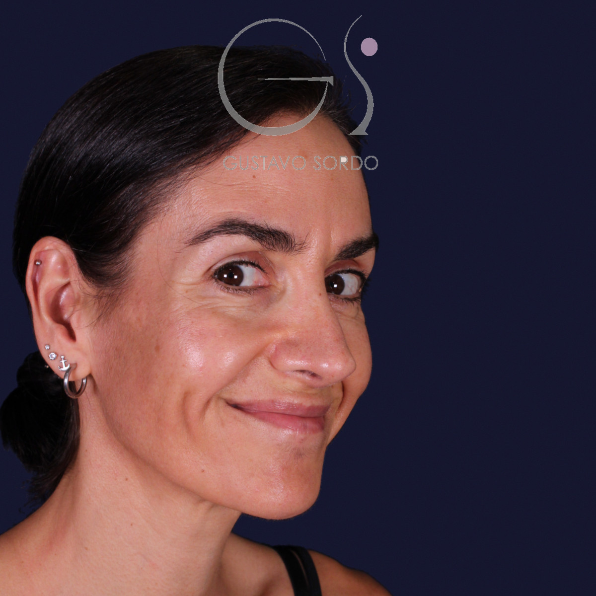 Rinoplastia de preservación con dorsal split y punta en armadillo, semiperfil derecho sonriendo: resultado a los 6 meses