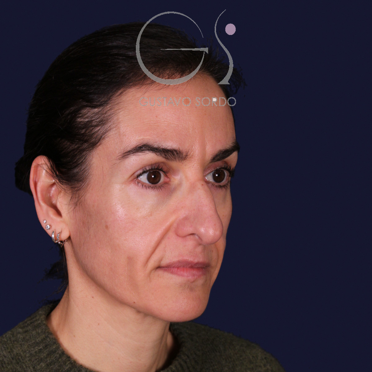 Rinoplastia de preservación con dorsal split y punta en armadillo, semiperfil derecho con gesto serio: antes de la operación