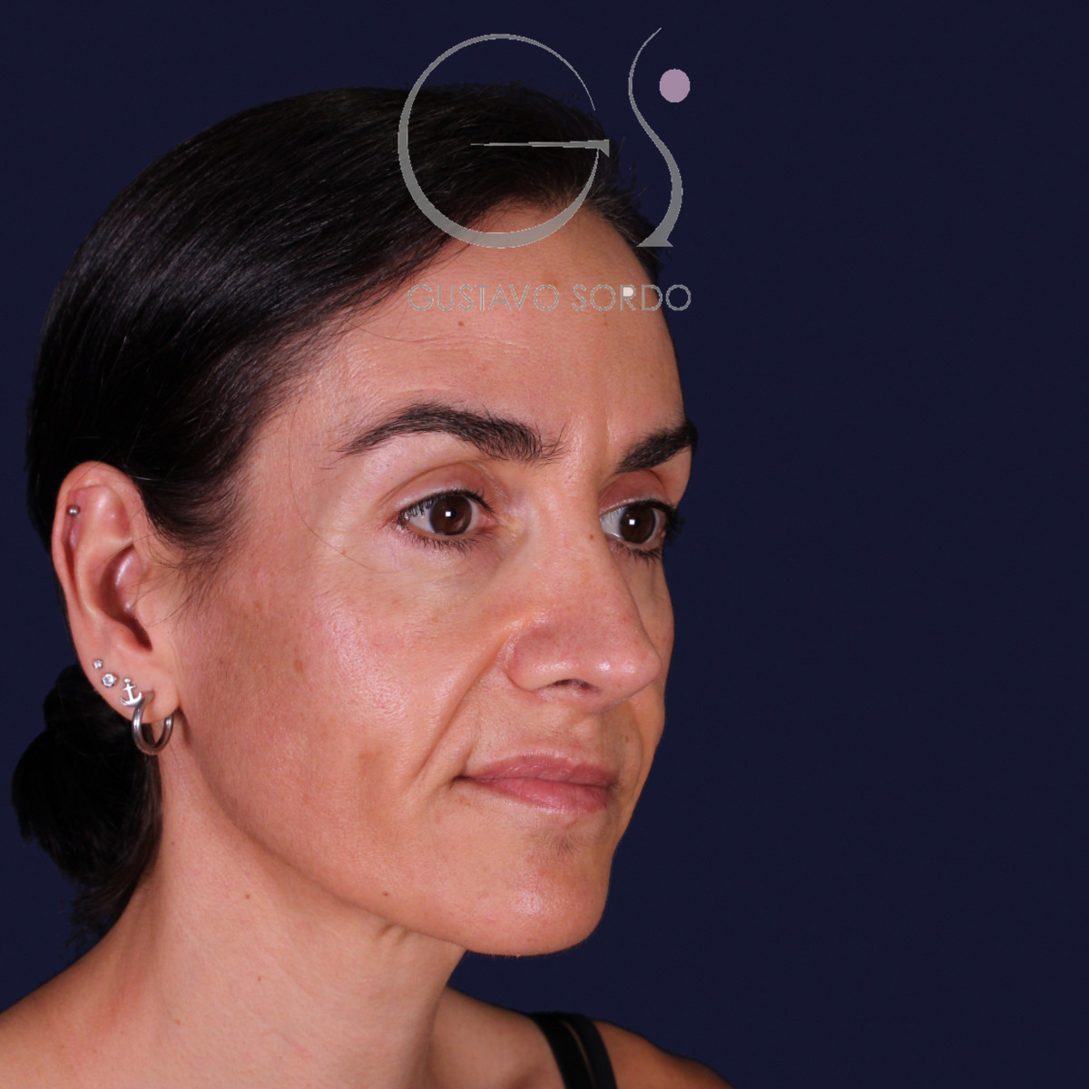 Rinoplastia de preservación con dorsal split y punta en armadillo, semiperfil derecho con gesto serio: resultado a los 6 meses