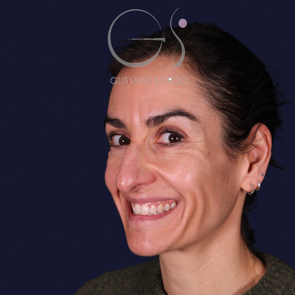 Rinoplastia de preservación con dorsal split y punta en armadillo, semiperfil izquierdo sonriendo: antes de la operación