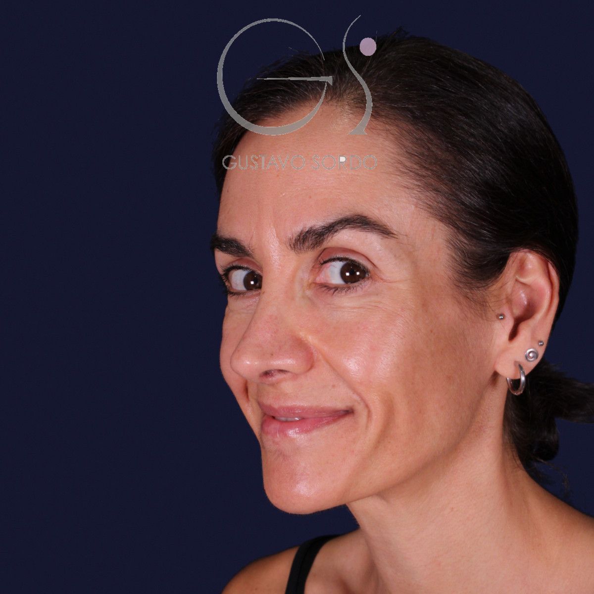 Rinoplastia de preservación con dorsal split y punta en armadillo, semiperfil izquierdo sonriendo: resultado a los 6 meses
