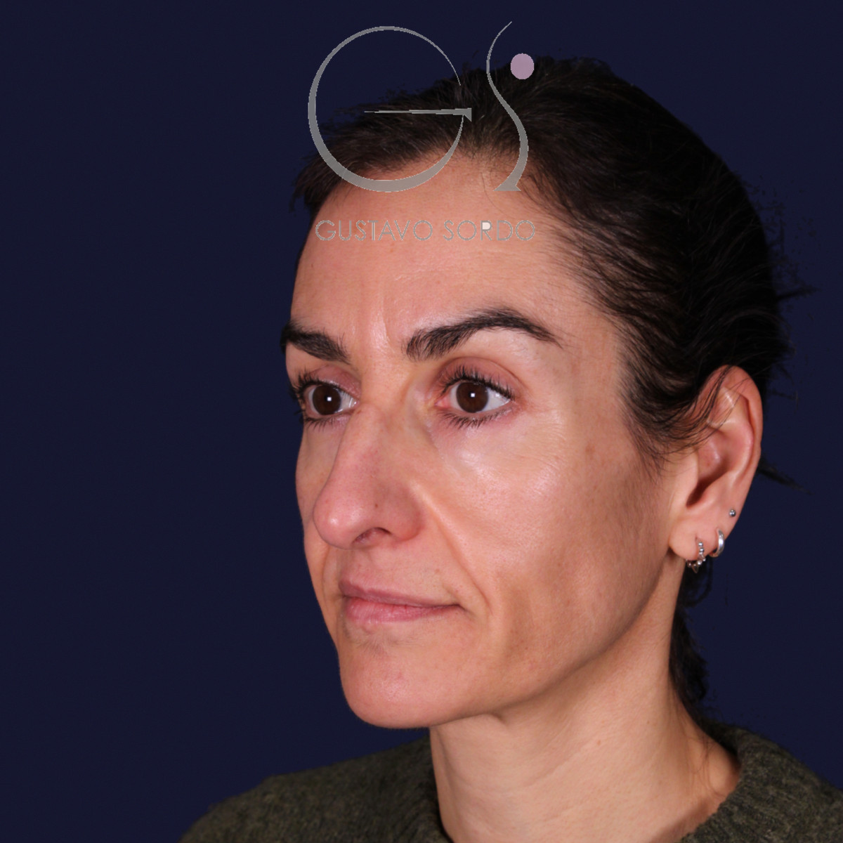 Rinoplastia de preservación con dorsal split y punta en armadillo, semiperfil izquierdo con gesto serio: antes de la operación
