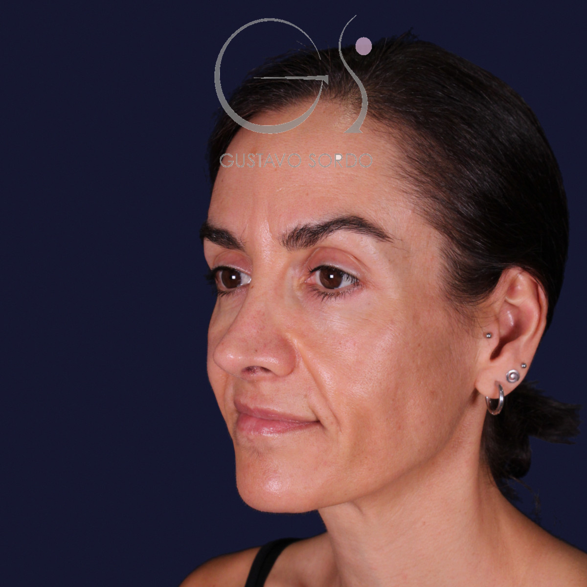 Rinoplastia de preservación con dorsal split y punta en armadillo, semiperfil izquierdo con gesto serio: resultado a los 6 meses