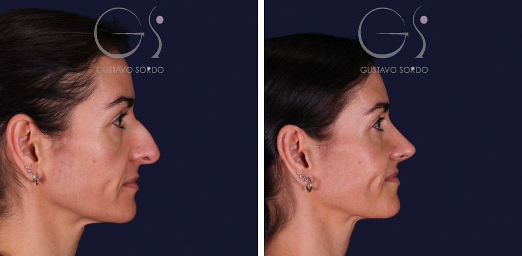 Rinoplastia de preservación con dorsal split y punta en armadillo: antes y después de un caso operado en Madrid