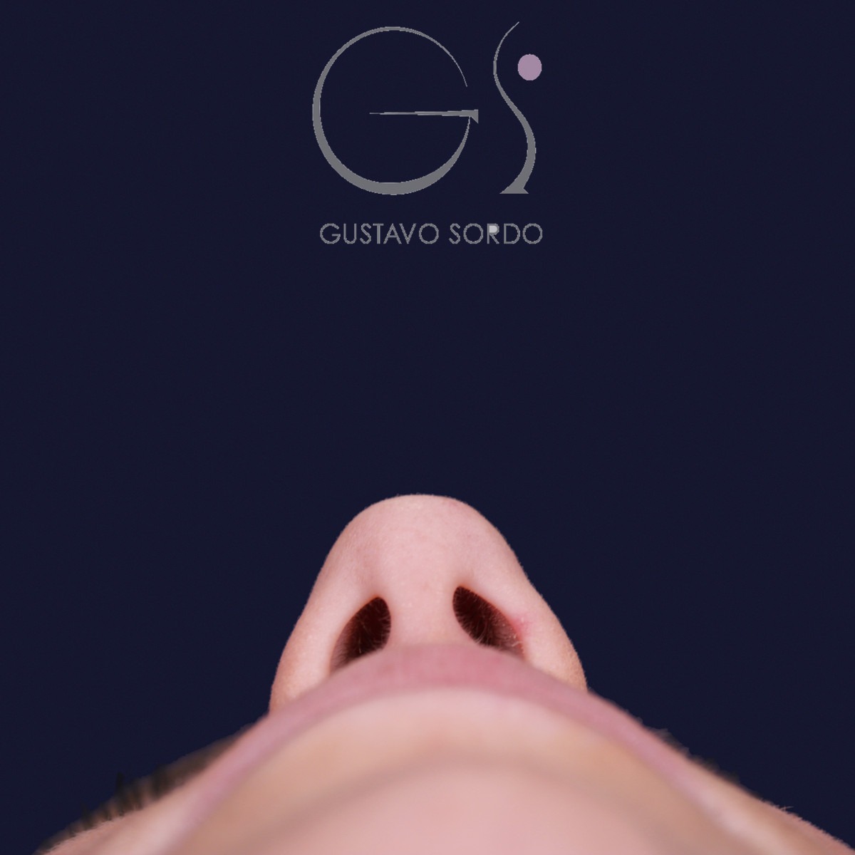 Rinoplastia estructural con dorso en S y spreader grafts, vista basal: antes de la operación