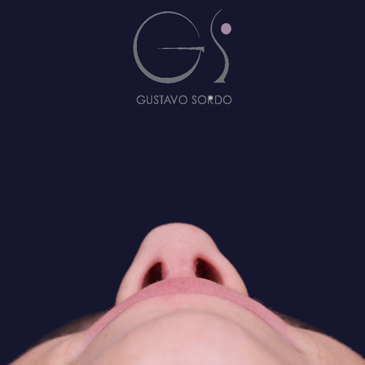 Rinoplastia estructural con dorso en S y spreader grafts, vista basal: resultado a los 17 meses