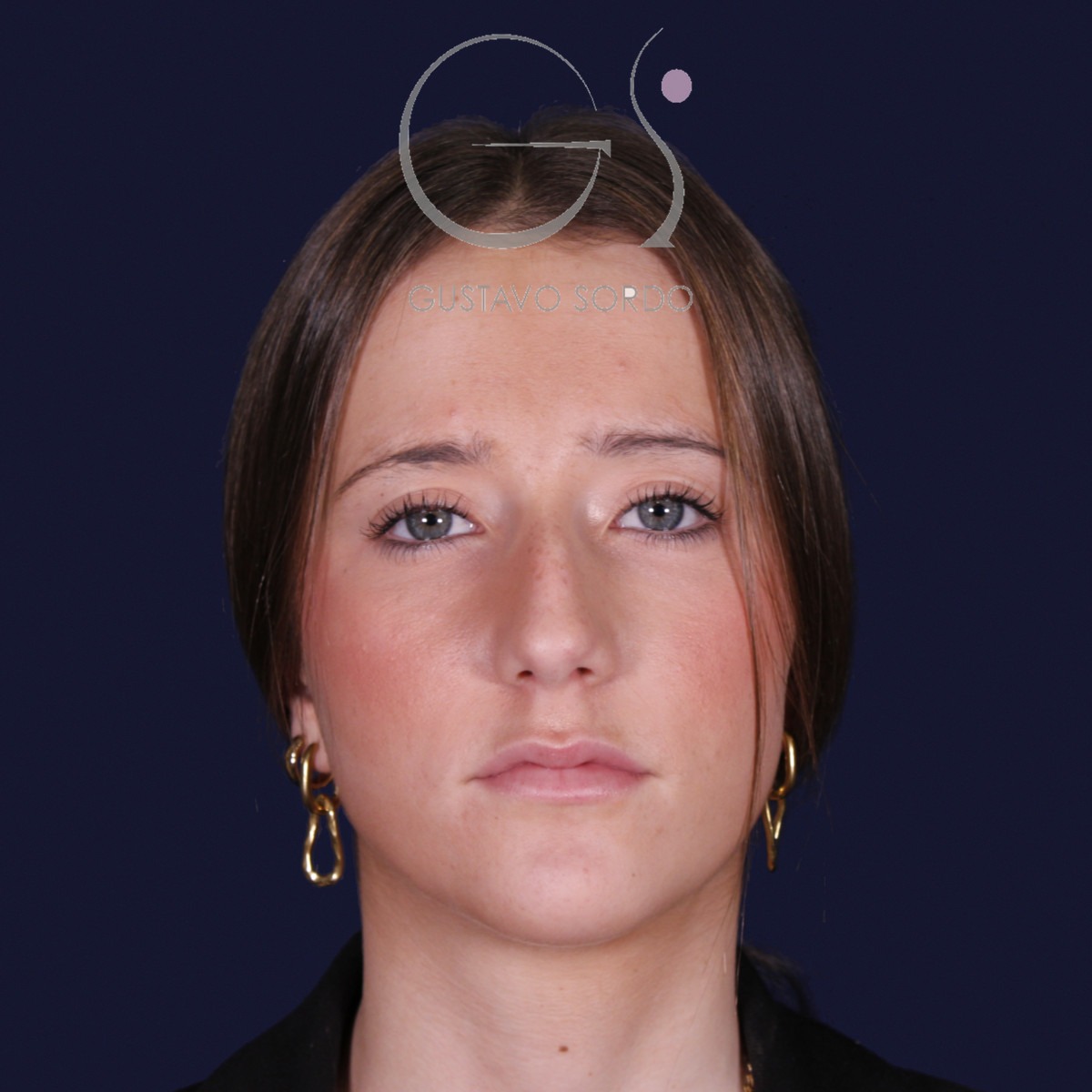 Rinoplastia estructural con dorso en S y spreader grafts, vista frontal: antes de la operación