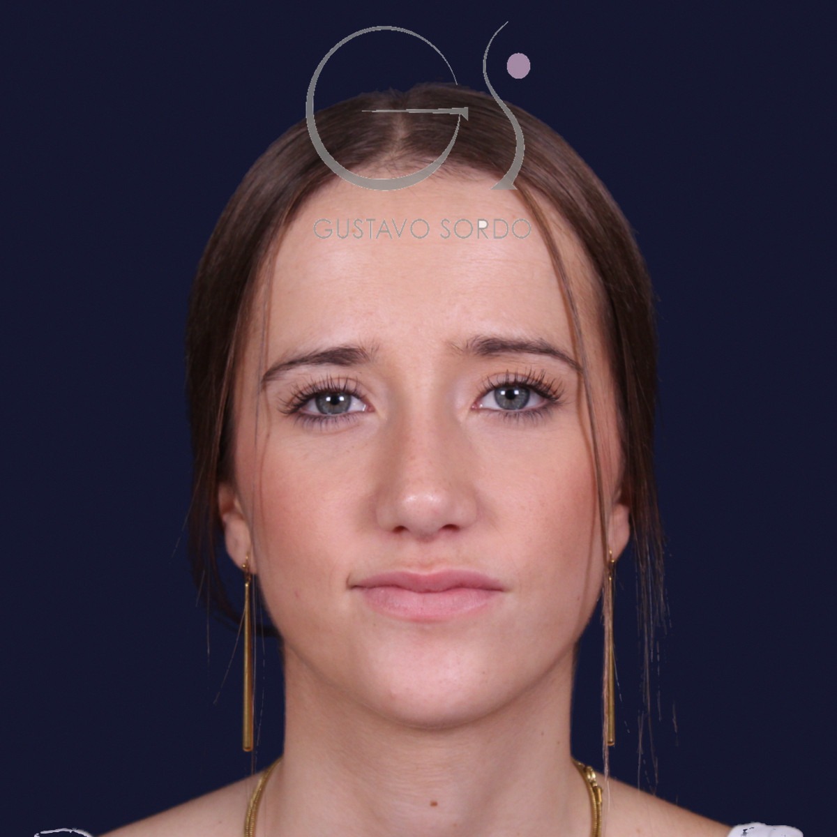 Rinoplastia estructural con dorso en S y spreader grafts, vista frontal: resultado a los 17 meses
