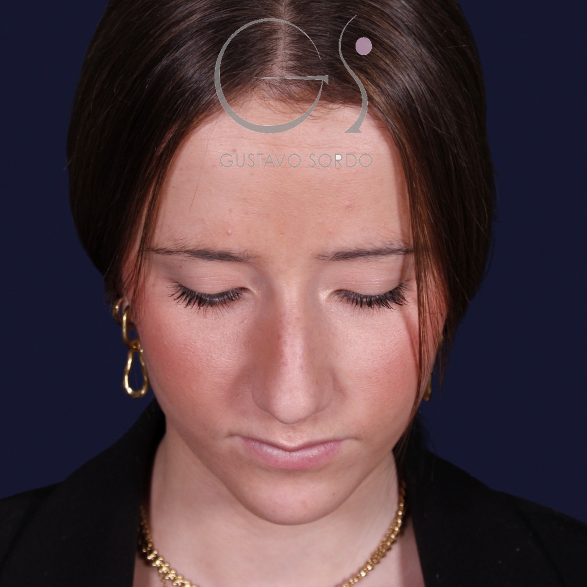 Rinoplastia estructural con dorso en S y spreader grafts, vista con el mentón abajo: antes de la operación