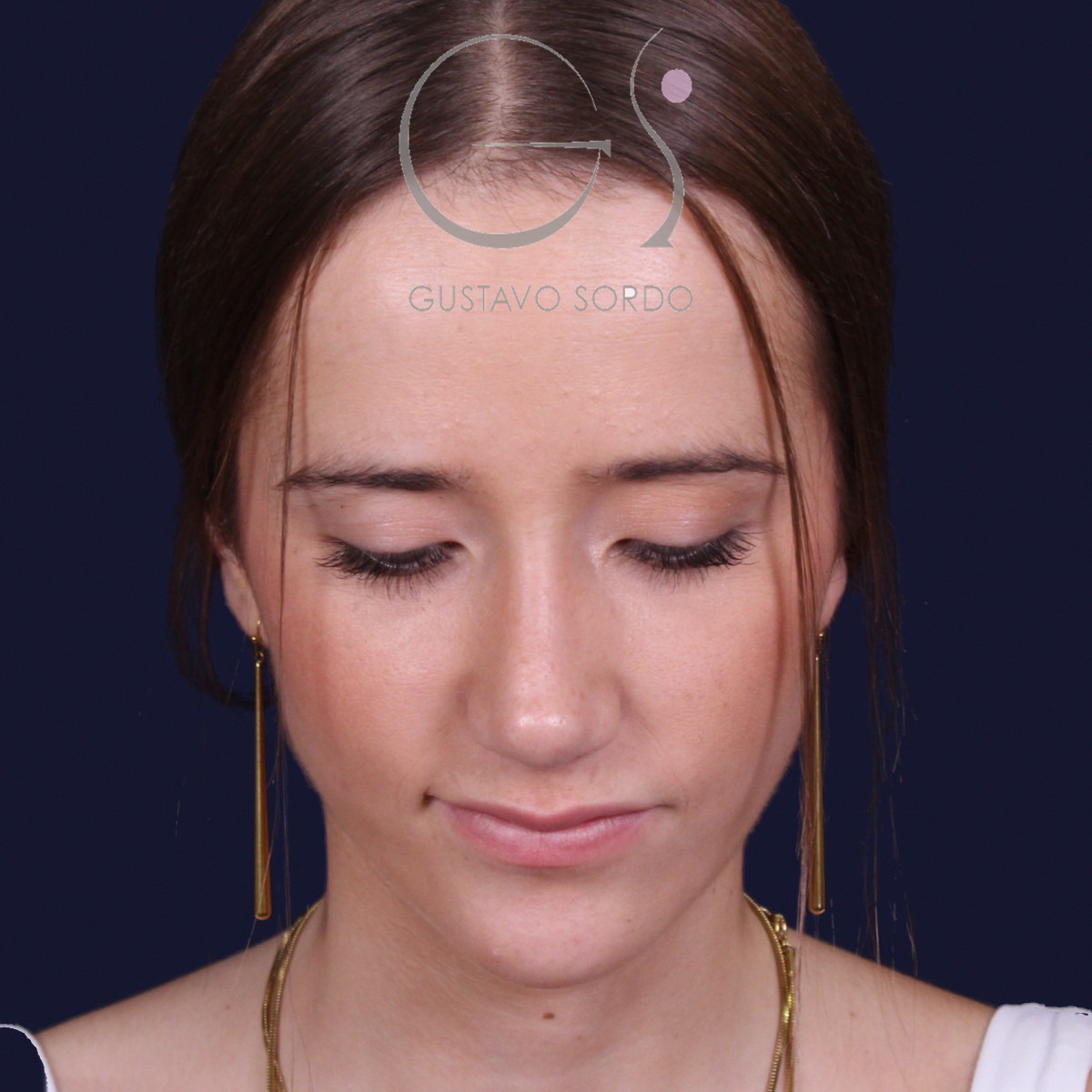 Rinoplastia estructural con dorso en S y spreader grafts, vista con el mentón abajo: resultado a los 17 meses
