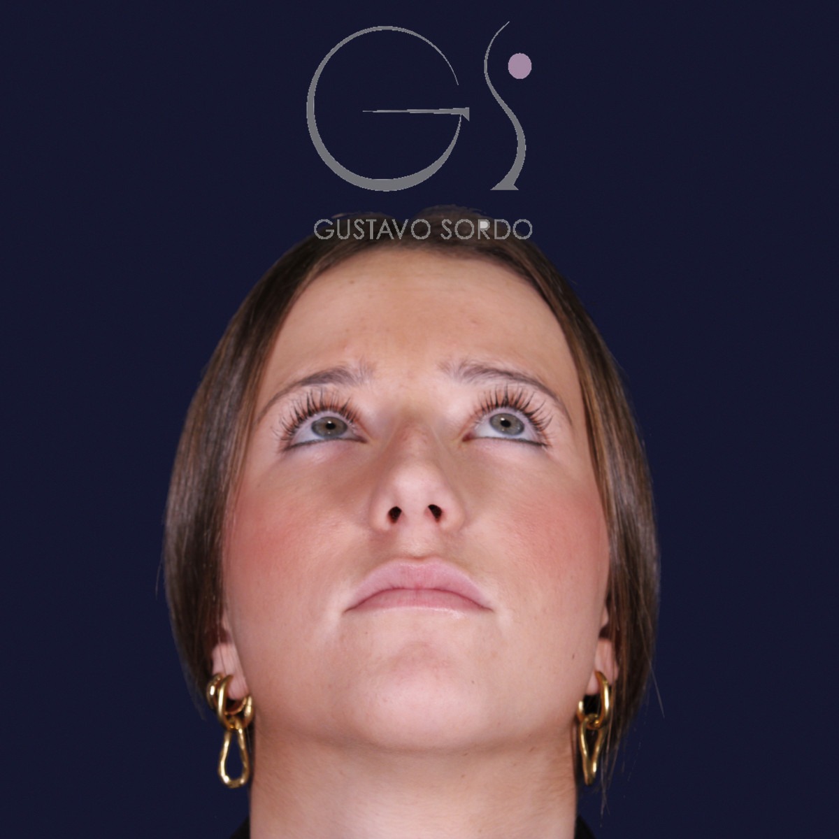 Rinoplastia estructural con dorso en S y spreader grafts, vista con el mentón arriba: antes de la operación