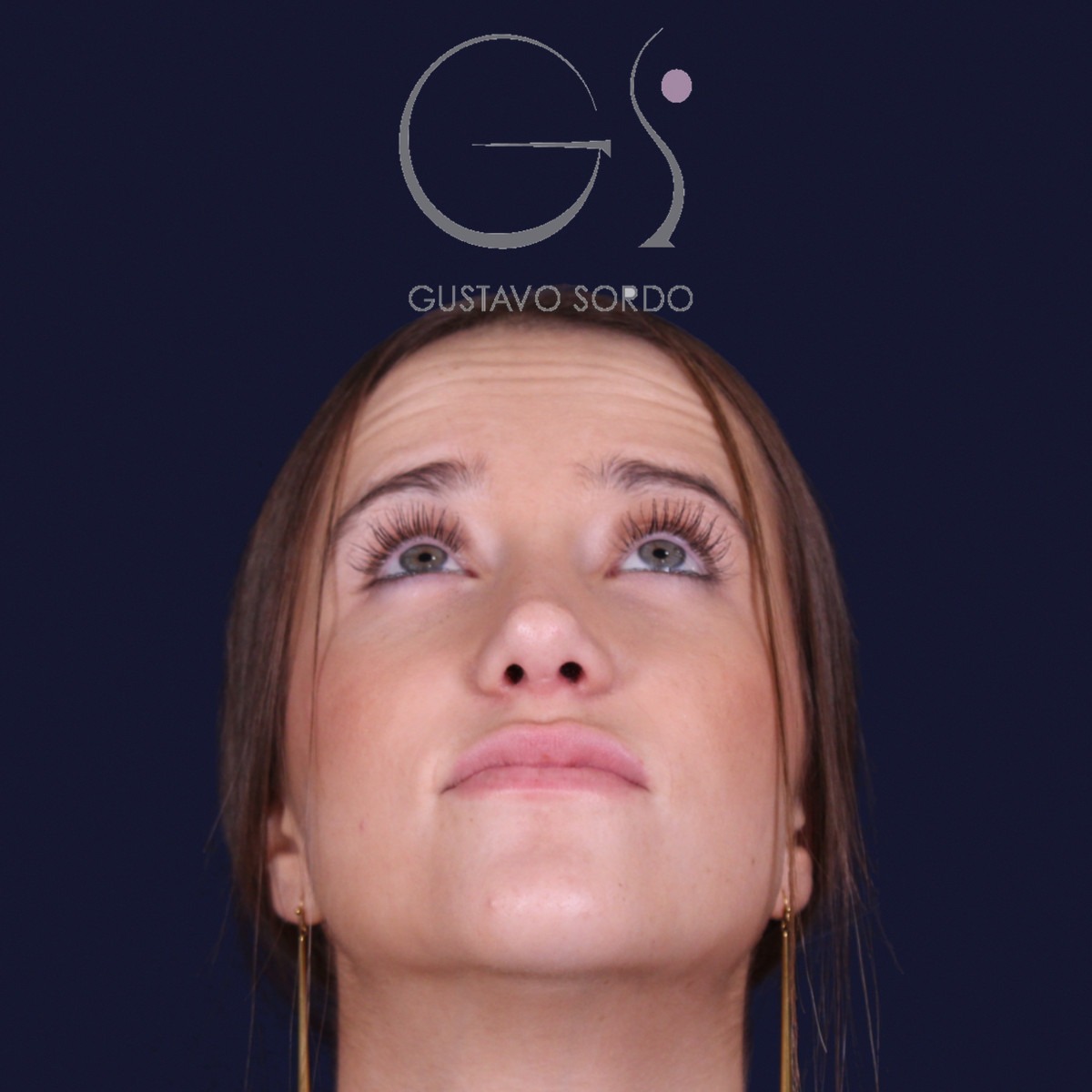 Rinoplastia estructural con dorso en S y spreader grafts, vista con el mentón arriba: resultado a los 17 meses
