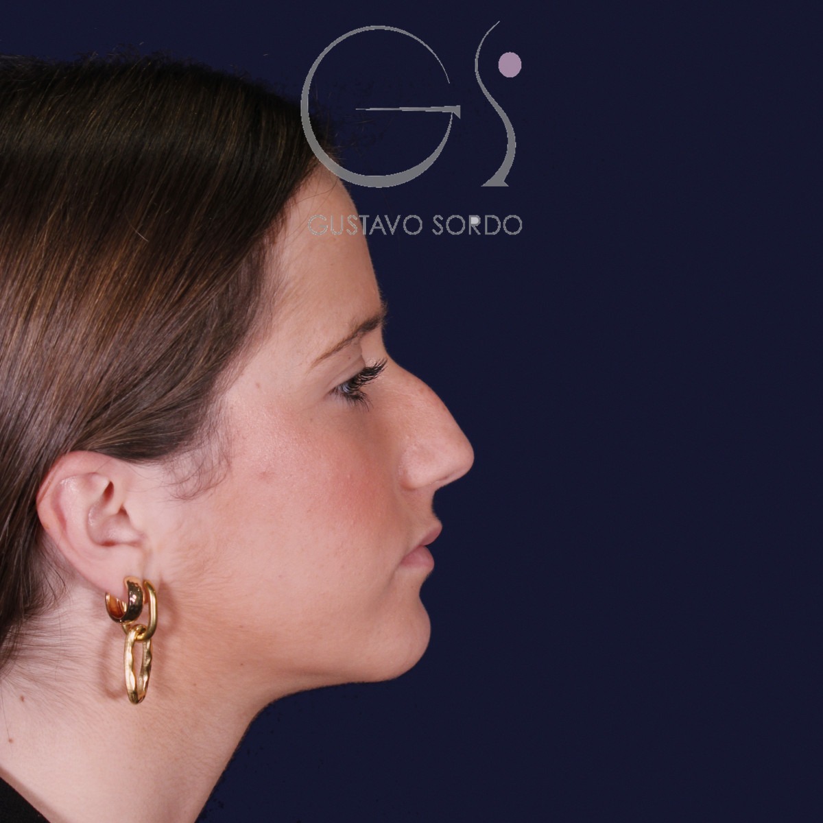 Rinoplastia estructural con dorso en S y spreader grafts, perfil derecho: antes de la operación