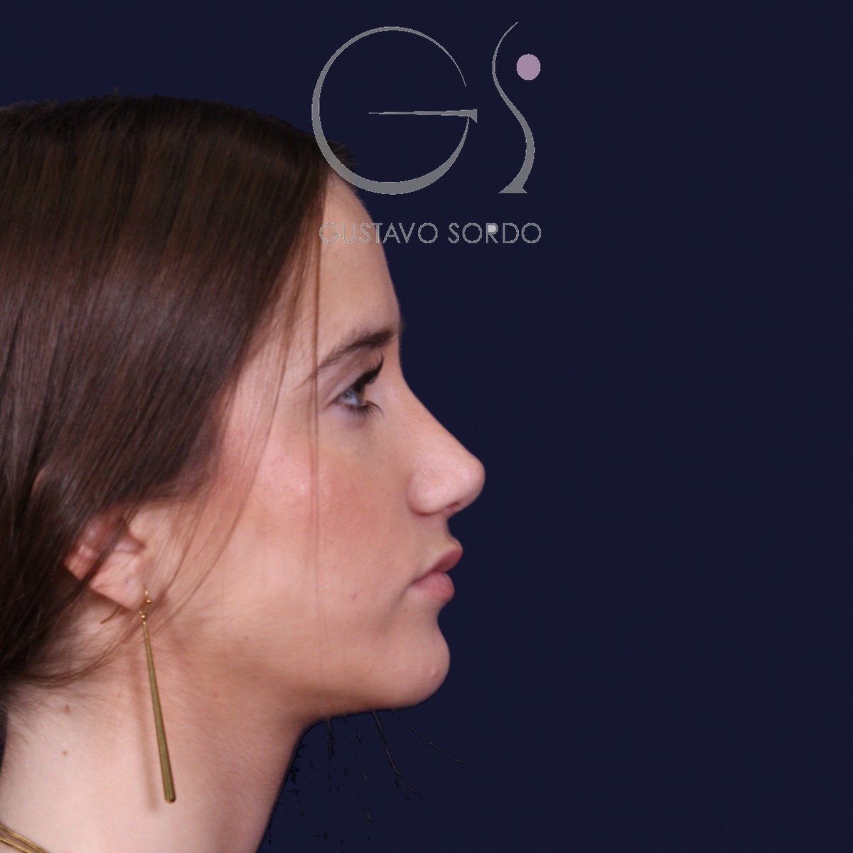 Rinoplastia estructural con dorso en S y spreader grafts, perfil derecho: resultado a los 17 meses