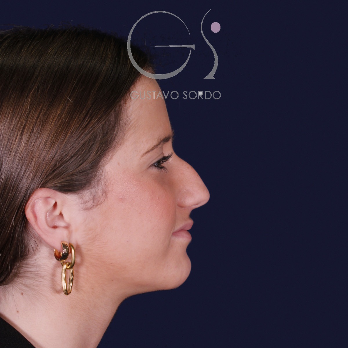Rinoplastia estructural con dorso en S y spreader grafts, perfil derecho sonriendo: antes de la operación