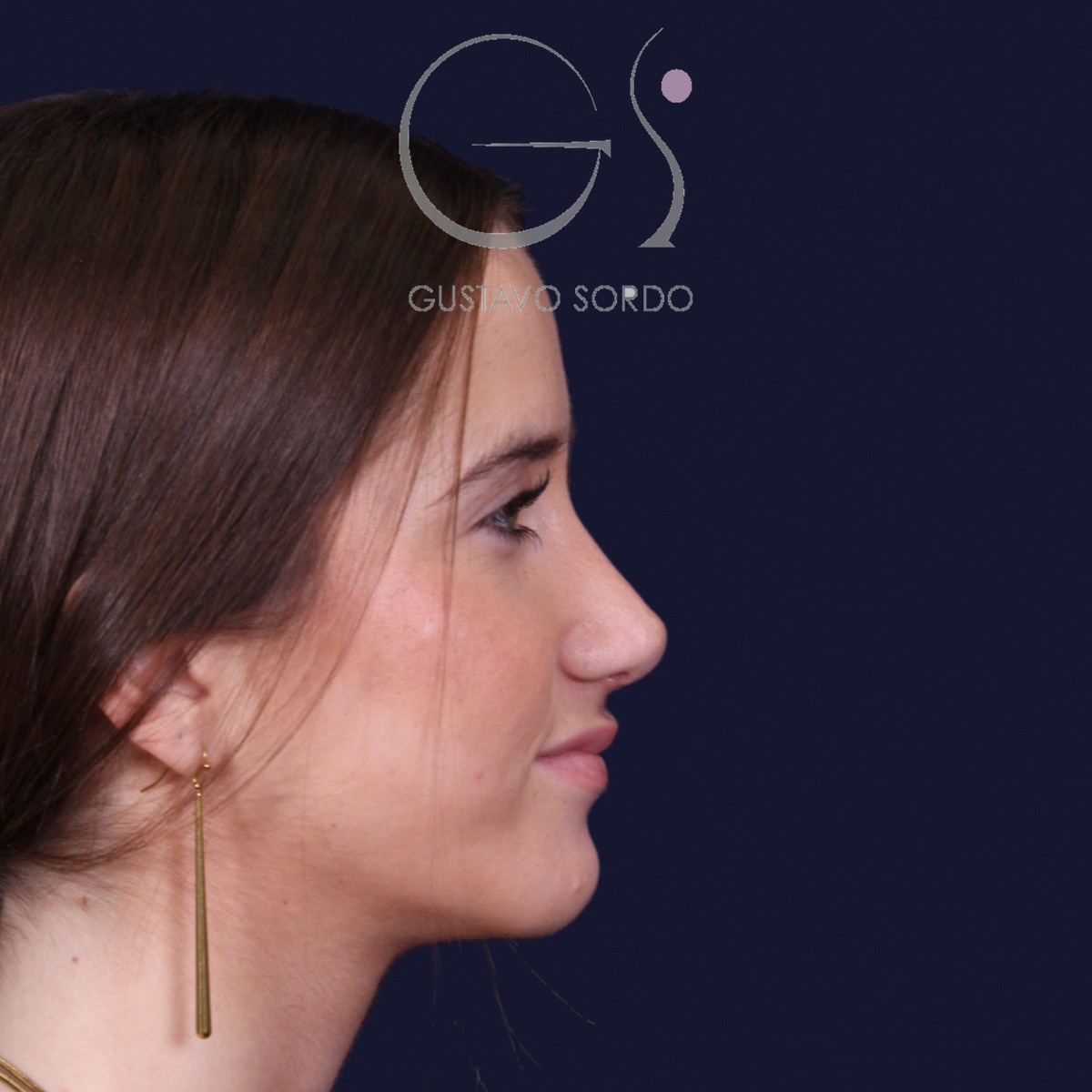Rinoplastia estructural con dorso en S y spreader grafts, perfil derecho sonriendo: resultado a los 17 meses
