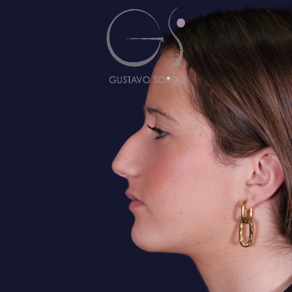 Rinoplastia estructural con dorso en S y spreader grafts, perfil izquierdo: antes de la operación