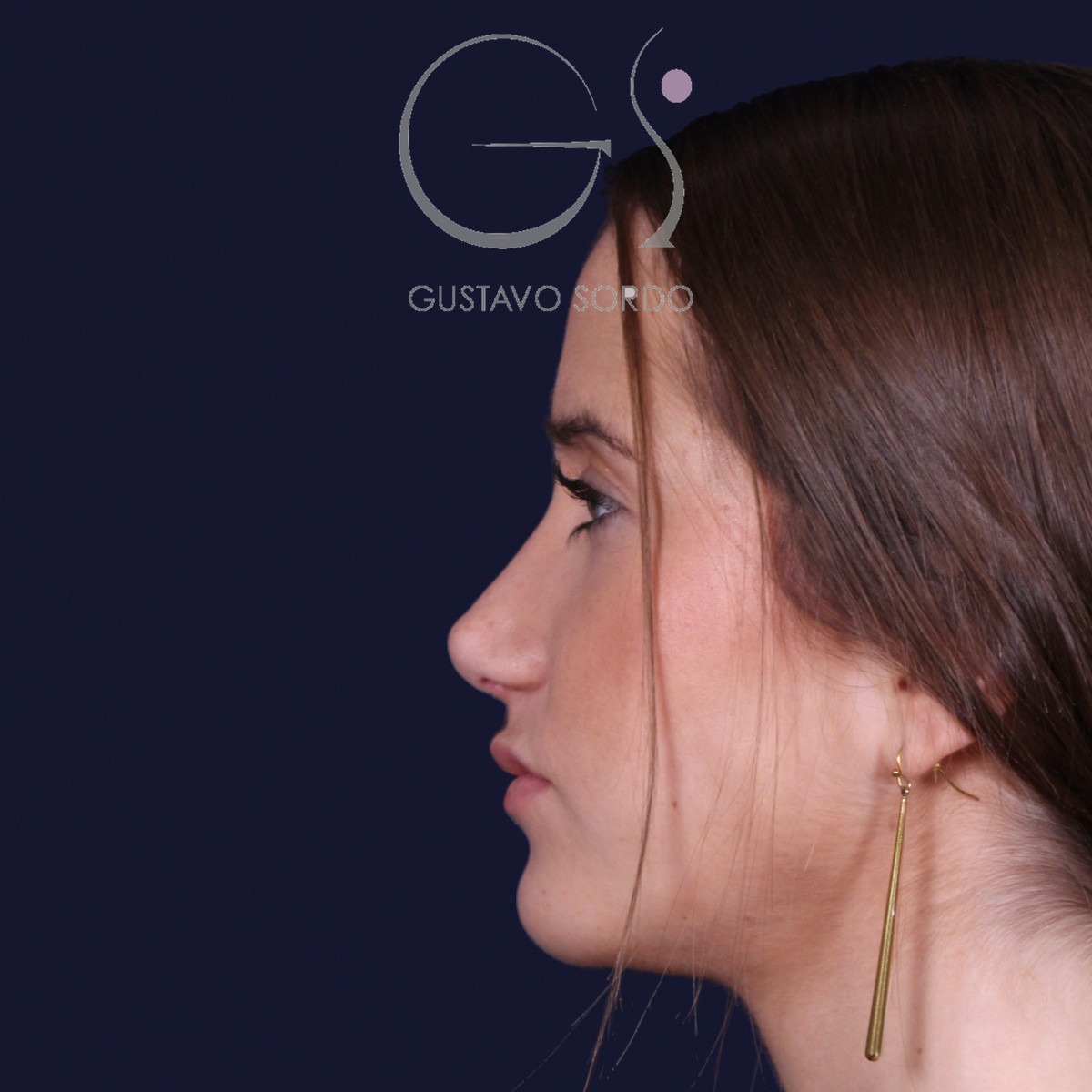 Rinoplastia estructural con dorso en S y spreader grafts, perfil izquierdo: resultado a los 17 meses